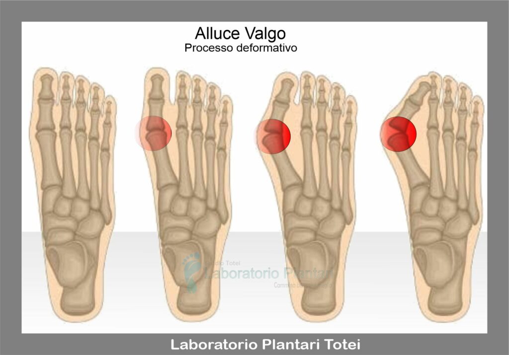 Plantari per Alluce Valgo