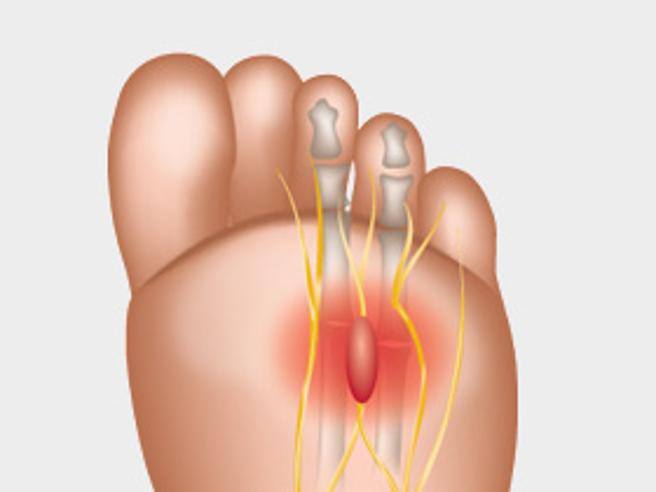 Neuroma di Morton, Laboratorio Plantari Totei