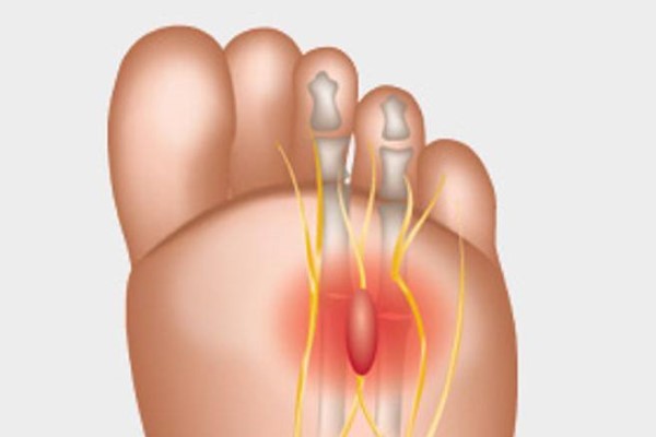 Neuroma di Morton, Laboratorio Plantari Totei