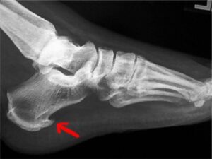 Sperone Calcaneare