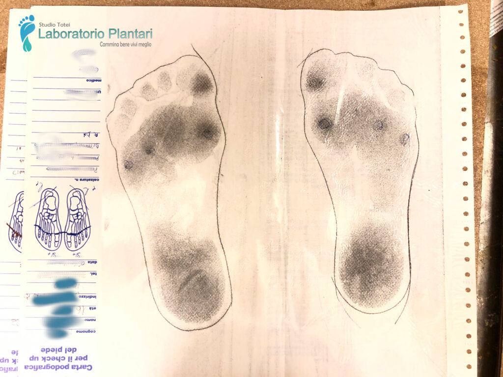 Plantari per Metatarsalgia, Plantari su misura, Laboratorio Plantari Totei, 