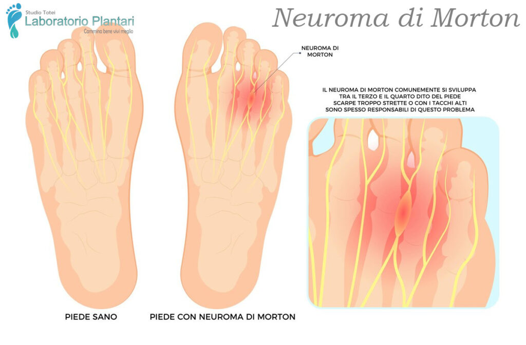 Neuroma di Morton, Laboratorio Plantari Totei